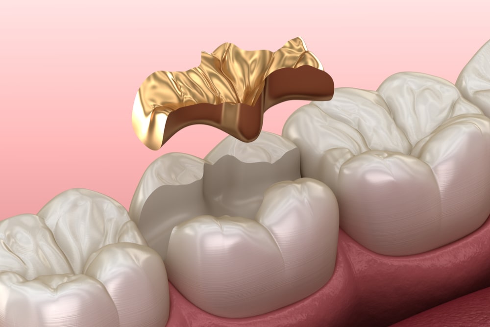 Golden Inlay crown fixation over tooth